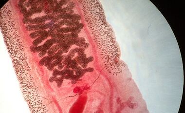 Anquilostomosis in man