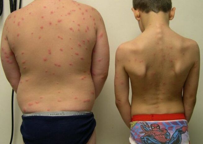 Rashes on the skin with worms