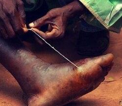 Parasite at the feet of a person