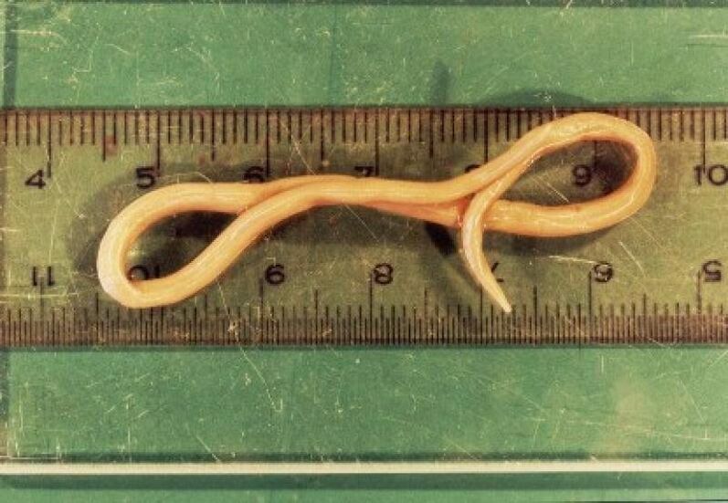 nematode parasite from the human body