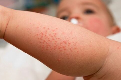 Allergy in a child as a symptom of the presence of worms